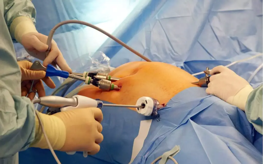 What is the BMI Eligibility for Bariatric Surgery in India?