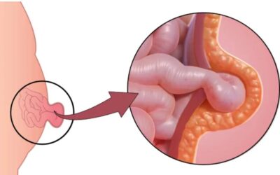 After a Hernia Operation What to Expect & What to Do for a Smooth Recovery