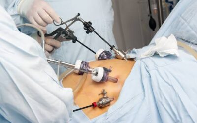 How Long Is Gallbladder Surgery Recovery?