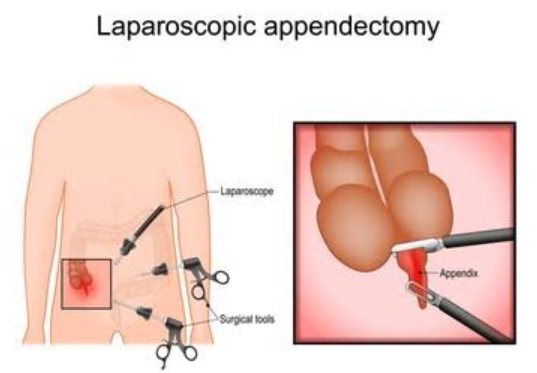 Diagram of laparoscopic appendectomy showing abdominal ports and instruments; inset shows the appendix being removed.