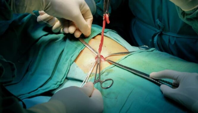 Diagram of laparoscopic appendectomy showing abdominal ports and instruments; inset shows the appendix being removed.